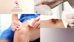 مزایای استفاده از آب اکسیژنه برای زخم‌ها